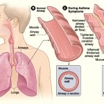 What is it that causes an asthma attack