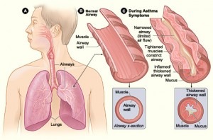 What is it that causes an asthma attack