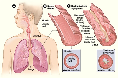 What is it that causes an asthma attack