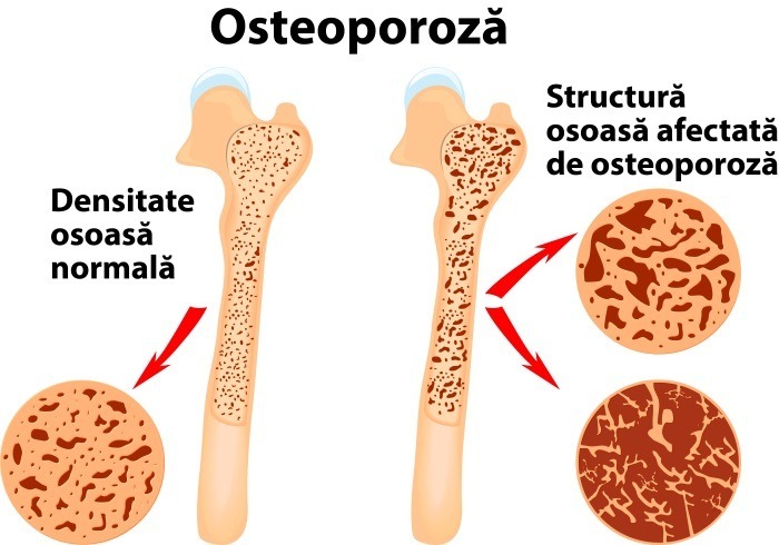 Osteoporoza: Cauze, diagnostic, tratament