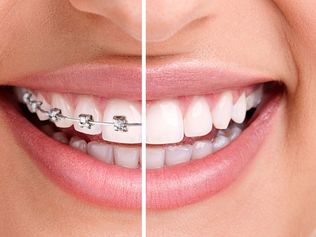 Tipuri de aparate dentare